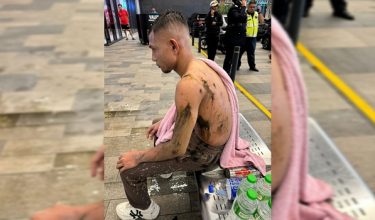 Gambar tular Faisal Halim cedera selepas diserang dengan cecair dipercayai asid